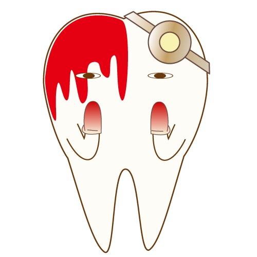 出血　腫れ　歯周病　むし歯　歯肉炎